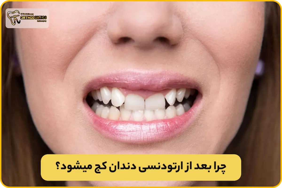 کج شدن دندان بعد از ارتودنسی