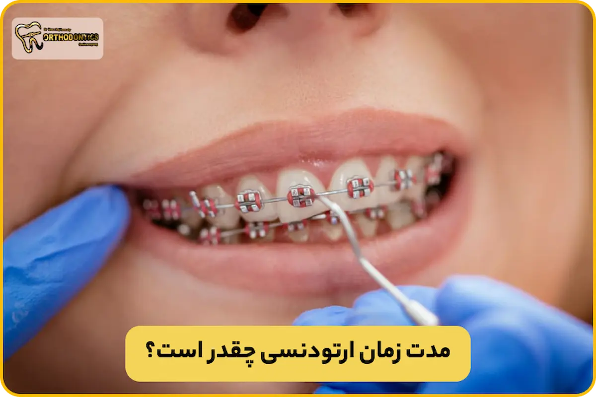 مدت زمان ارتودنسی چقدر است؟