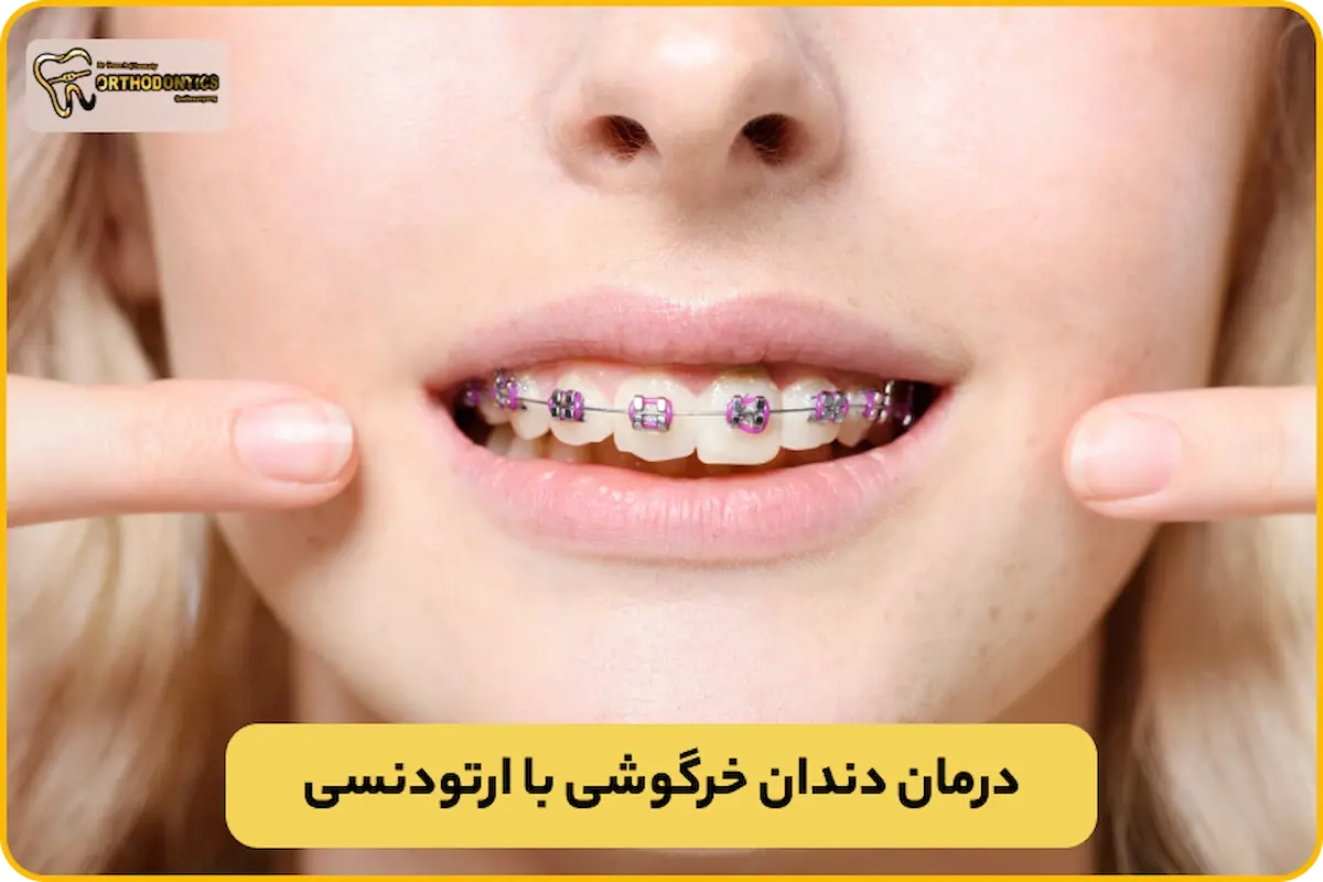 درمان دندان خرگوشی با ارتودنسی