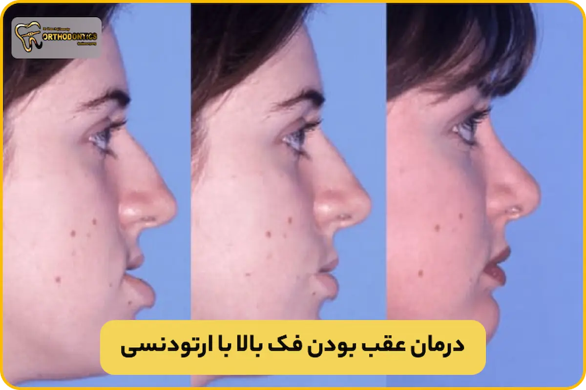عقب بودن فک بالا