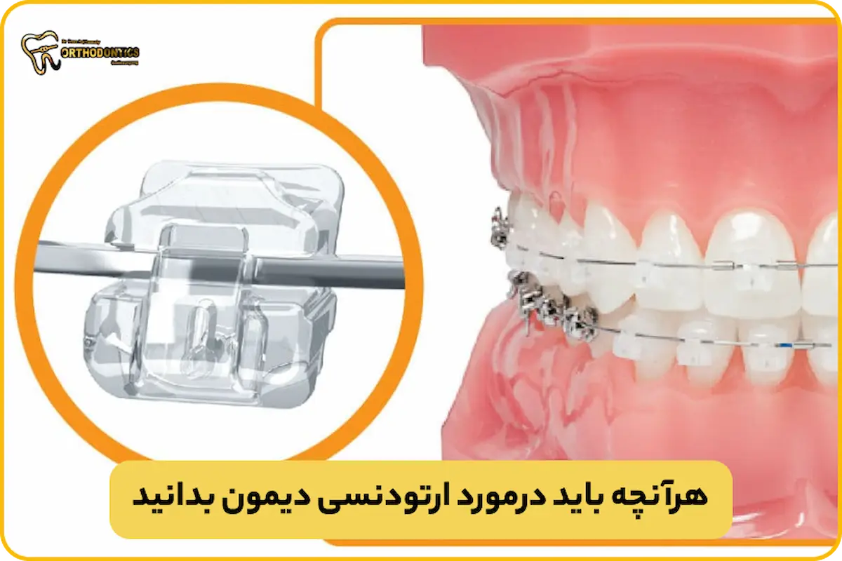 ارتودنسی دیمون چیست