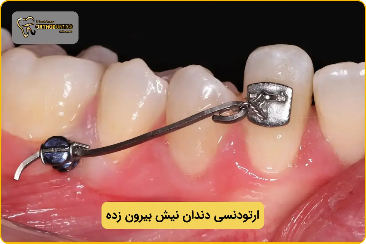 ارتودنسی دندان نیش بیرون زده یا نهفته