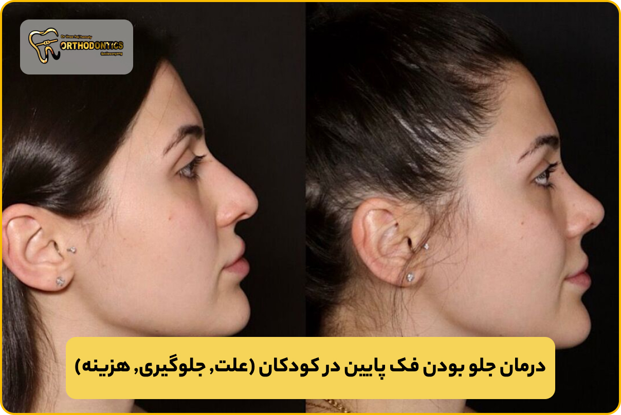 جلو بودن فک پایین در کودکان