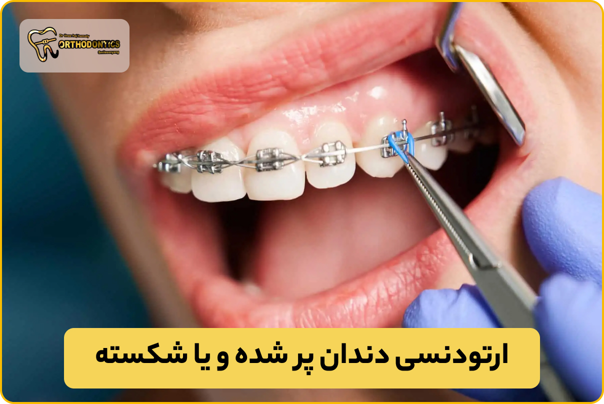 ارتودنسی دندان پر شده و یا شکسته