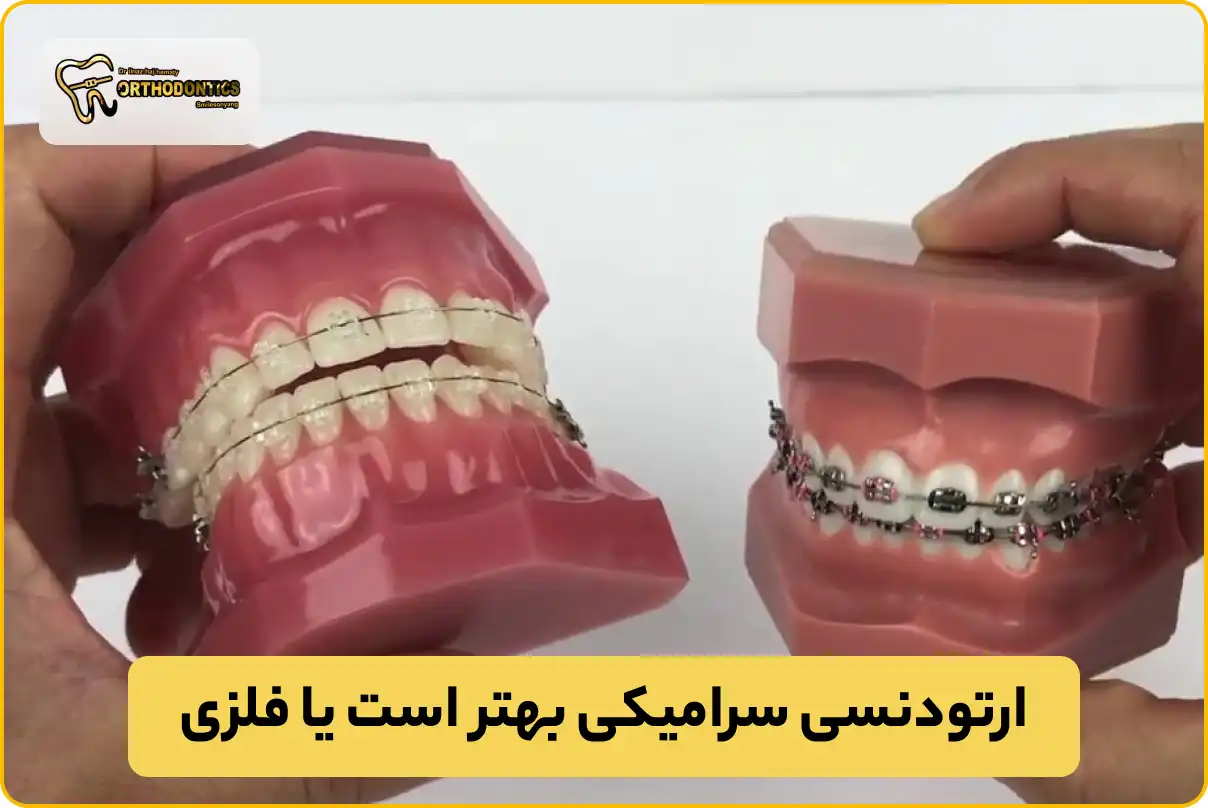 ارتودنسی سرامیکی بهتر است یا فلزی