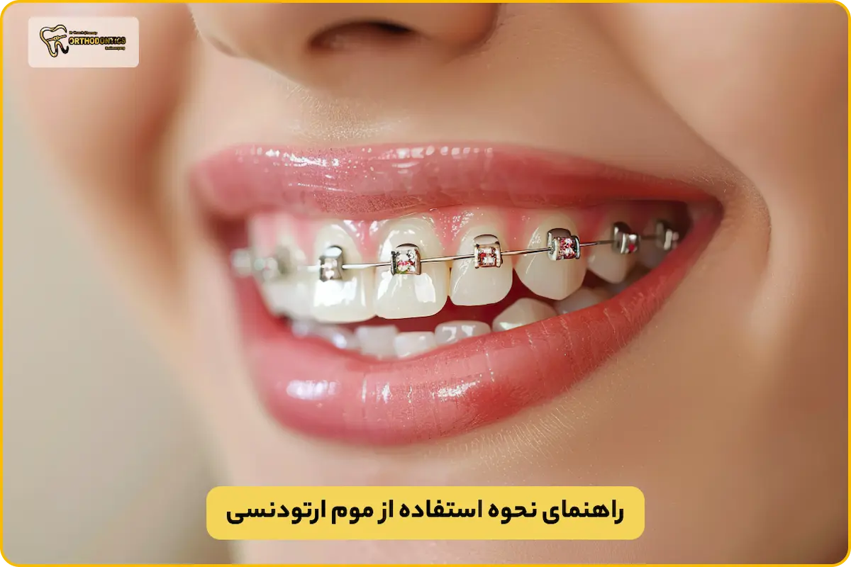 نحوه استفاده از موم ارتودنسی