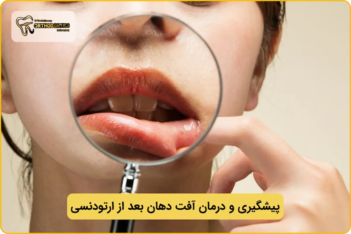 آفت دهان در ارتودنسی