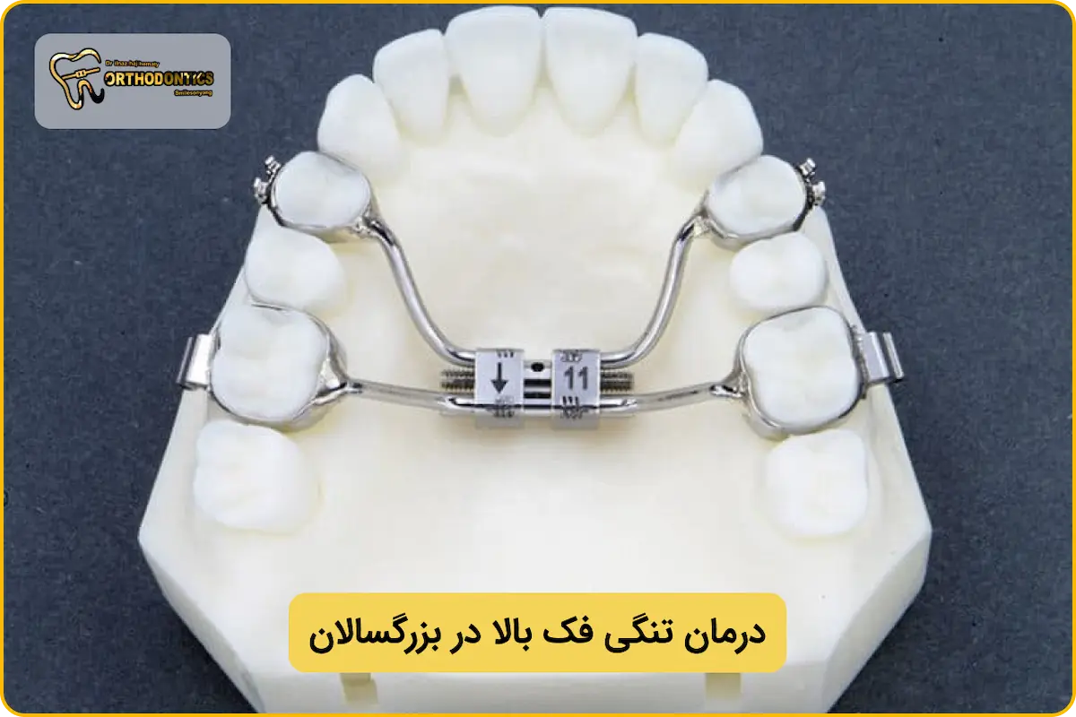تنگی فک بالا در بزرگسالان