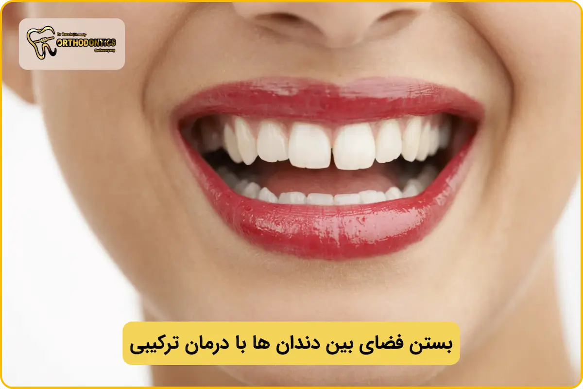 بستن فضای بین دندان ها با درمان ترکیبی