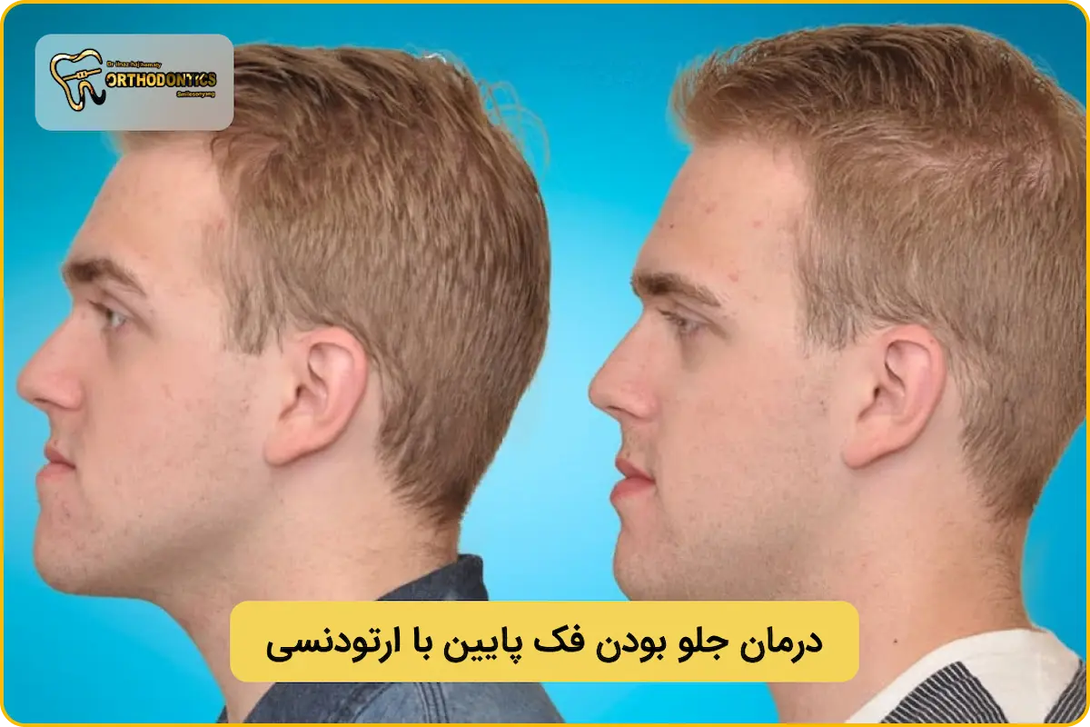 ارتودنسی فک پایین جلو آمده بدون جراحی