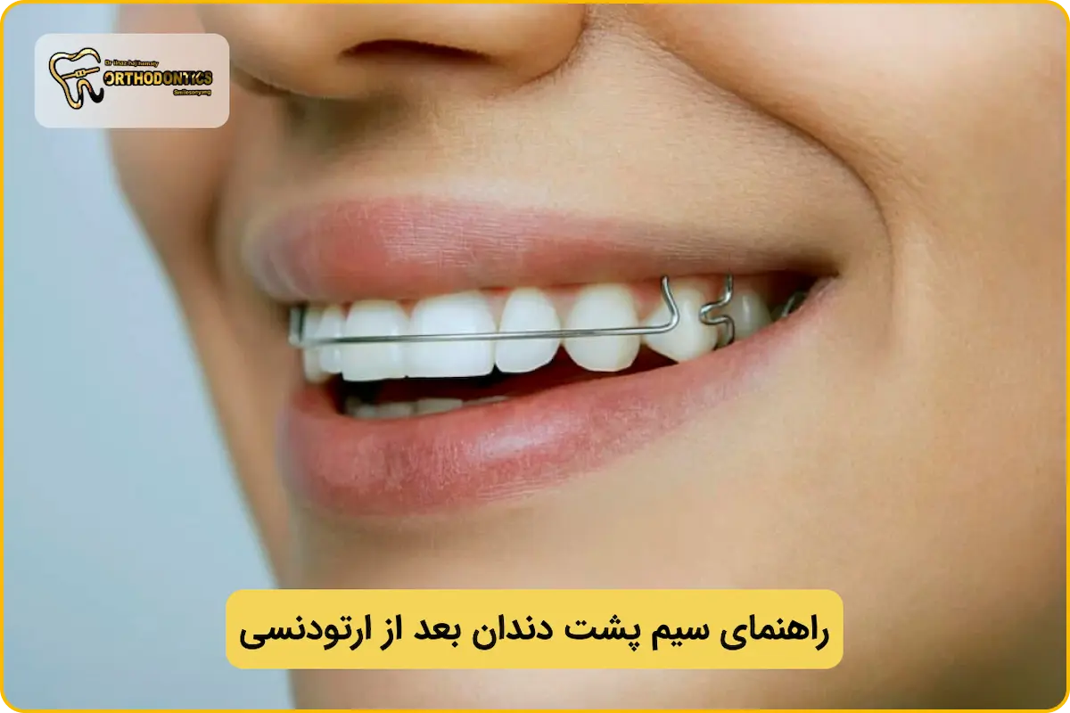 سیم پشت دندان بعد از ارتودنسی