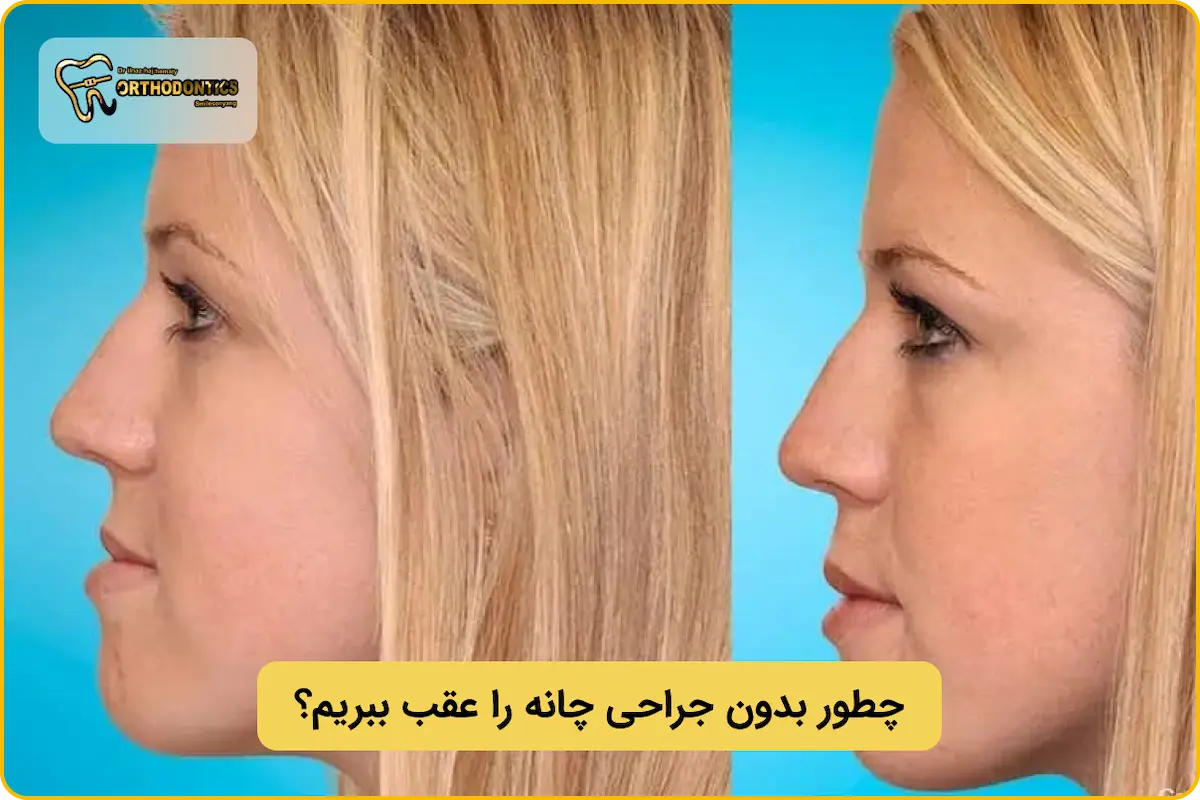 عقب بردن چانه بدون جراحی
