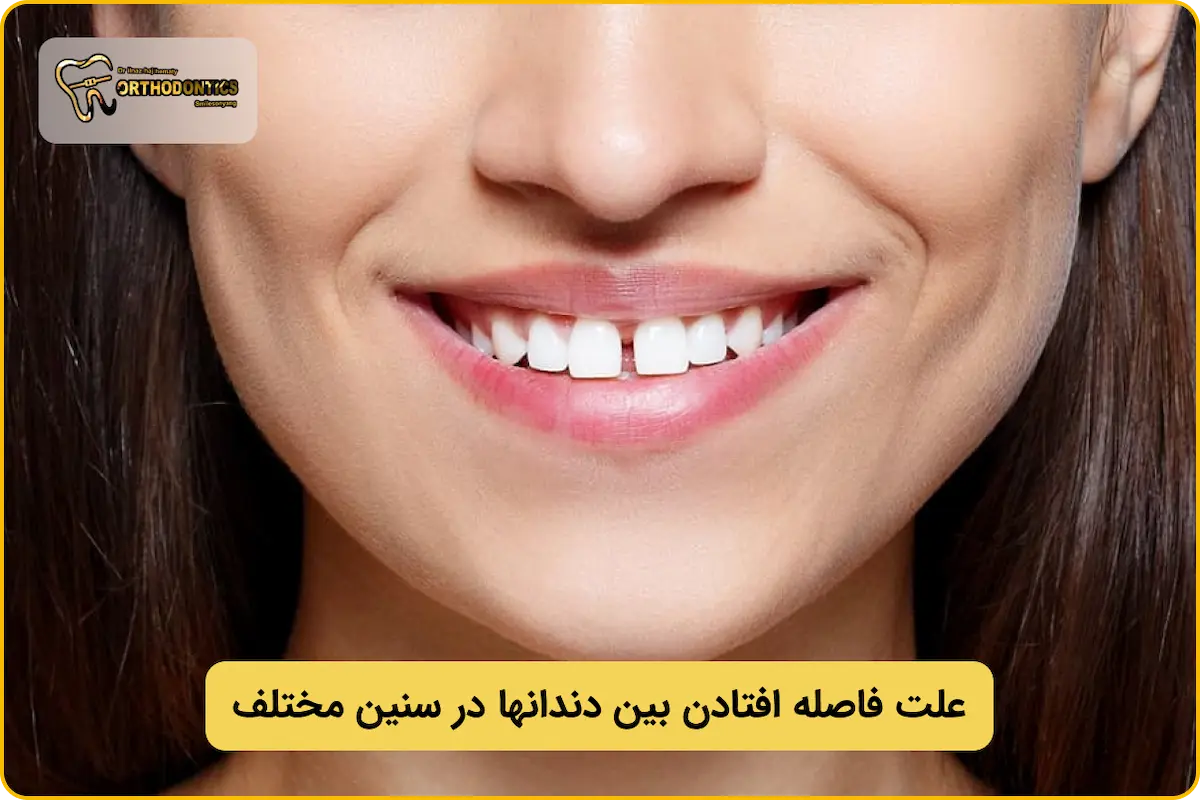 علت فاصله افتادن بین دندانها