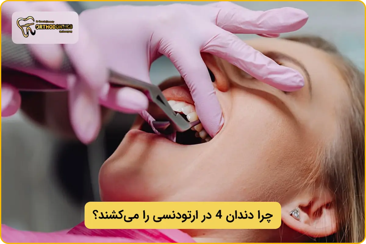کشیدن دندان 4 در ارتودنسی
