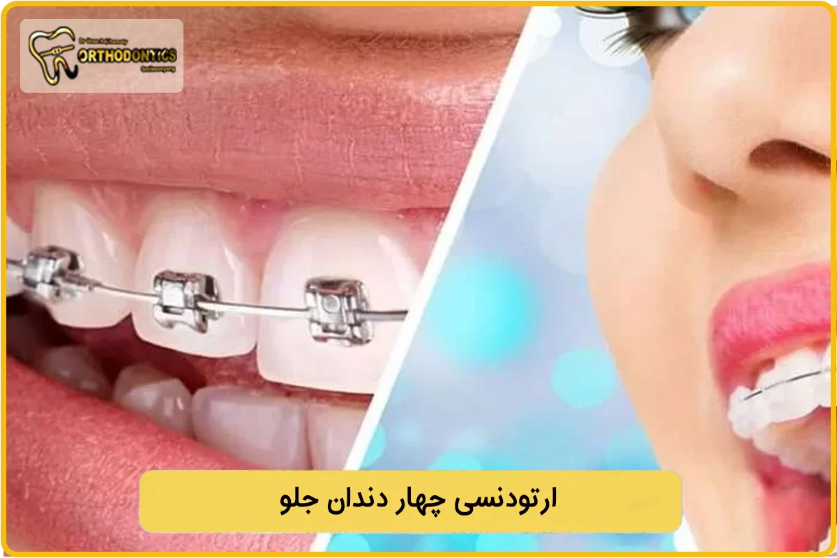 ارتودنسی چهار دندان جلو