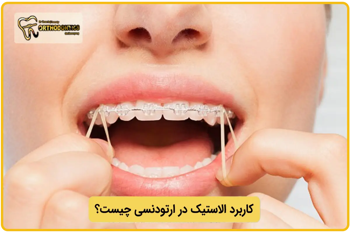 کاربرد الاستیک در ارتودنسی