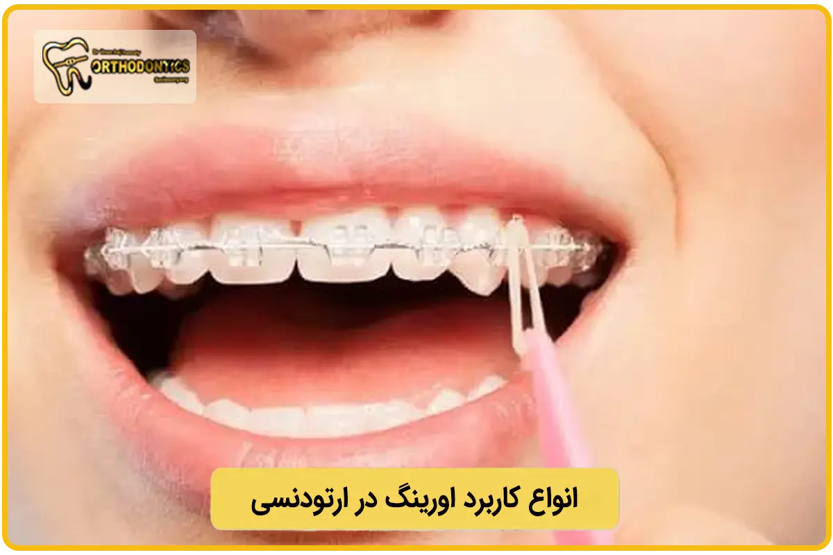 کاربرد اورینگ در ارتودنسی