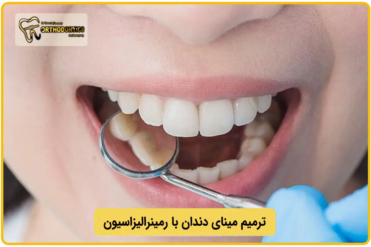ترمیم مینای دندان با رمینرالیزاسیون