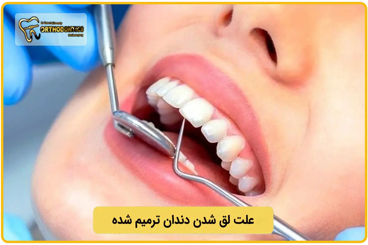 علت لق شدن دندان بعد از ترمیم