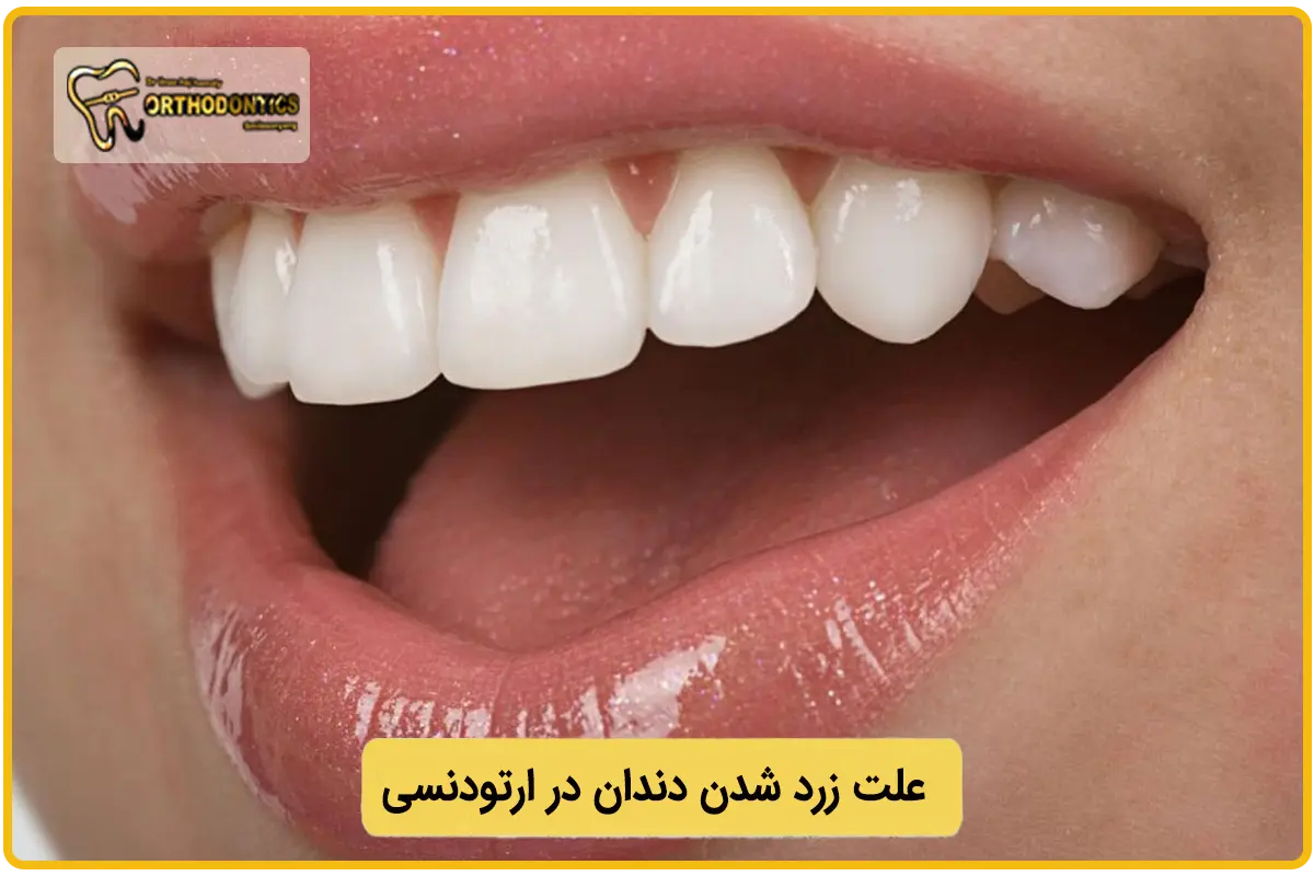 علت زرد شدن دندان در ارتودنسی