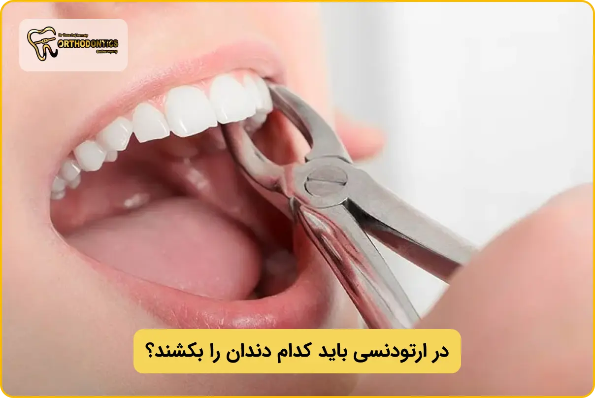 در ارتودنسی کدام دندان را میکشند