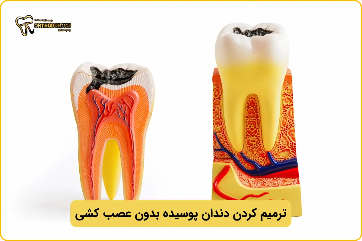 ترمیم دندان پوسیده بدون عصب کشی