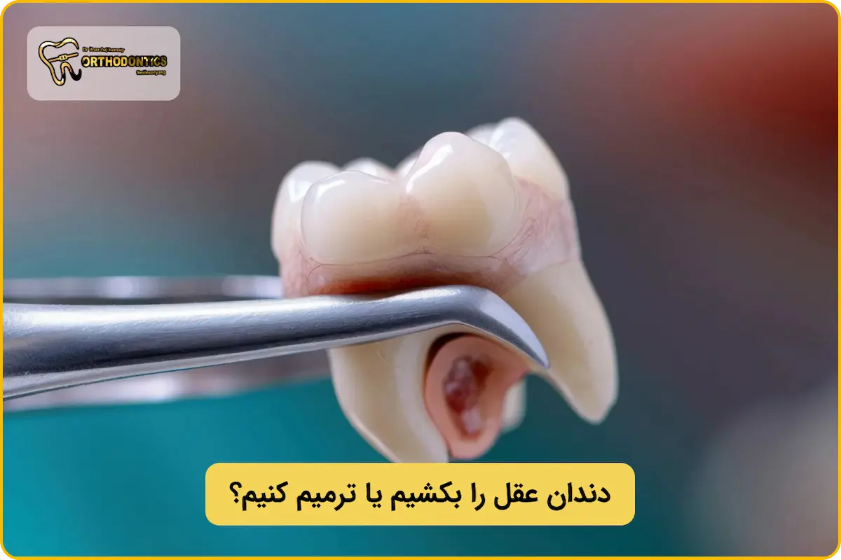 کشیدن یا ترمیم دندان عقل