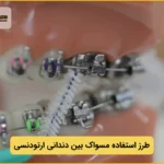 نحوه استفاده از مسواک بین دندانی ارتودنسی