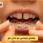 ارتودنسی دو دندان جلو؛ هزینه، مزایا و معایب
