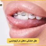 علت خشکی دهان در ارتودنسی و درمان آن