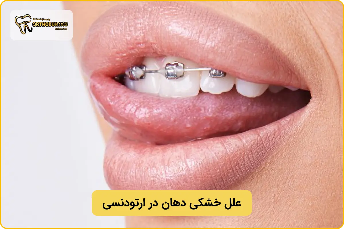 علت خشکی دهان در ارتودنسی