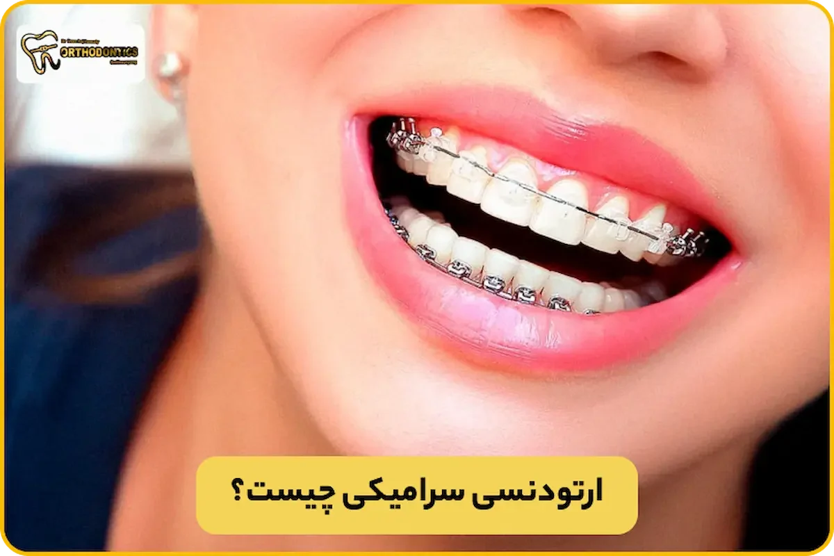 ارتودنسی سرامیکی