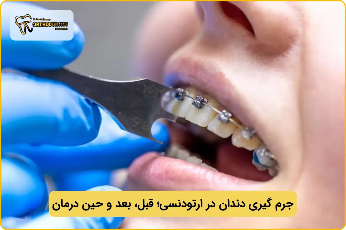 جرم گیری دندان در ارتودنسی