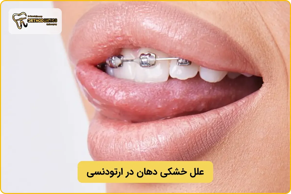 علت خشکی دهان در ارتودنسی