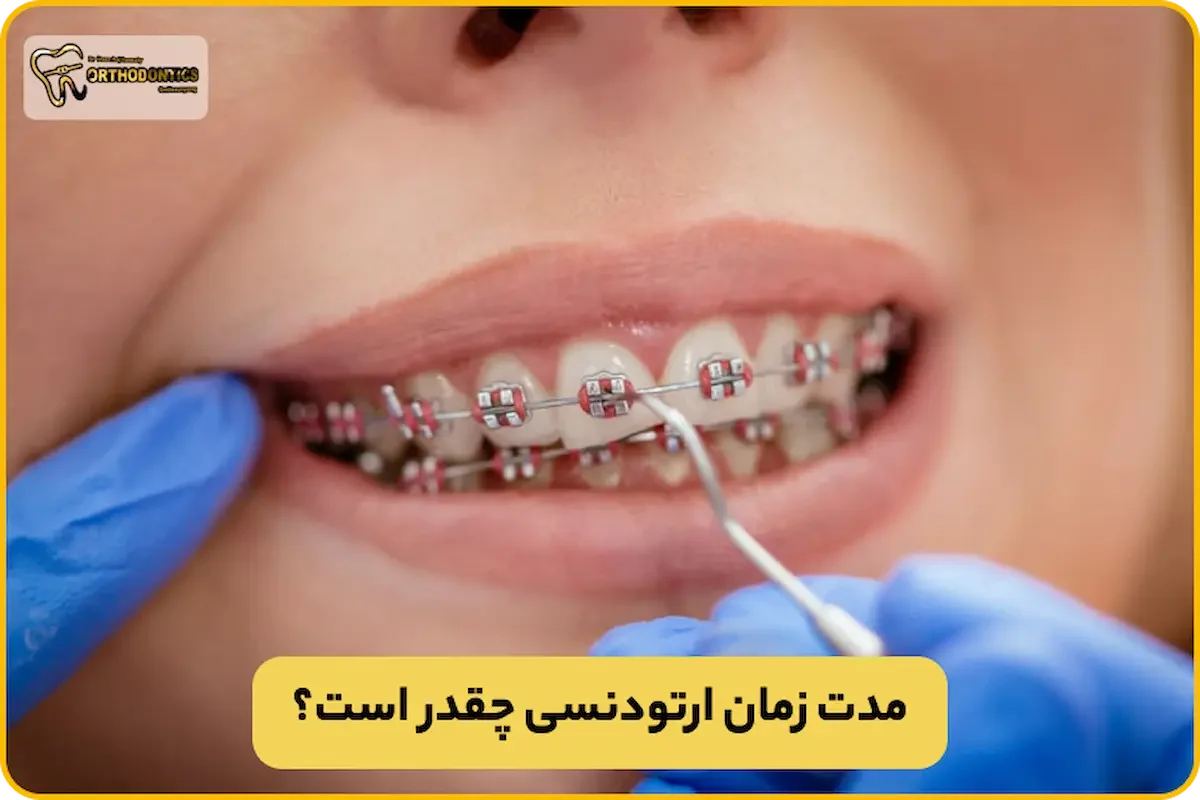 مدت زمان ارتودنسی چقدر است؟