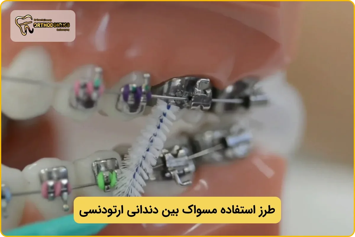 طریقه استفاده مسواک بین دندانی ارتودنسی
