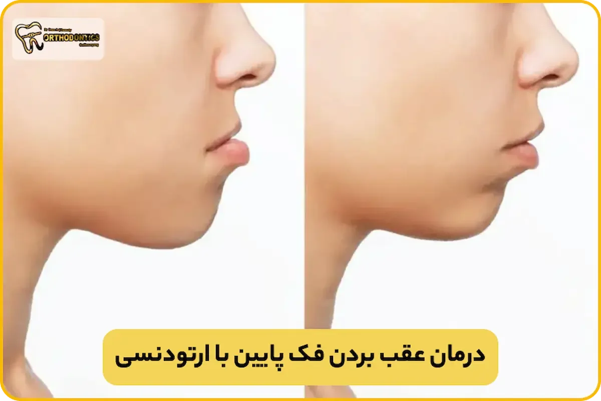 درمان عقب بردن فک پایین با ارتودنسی