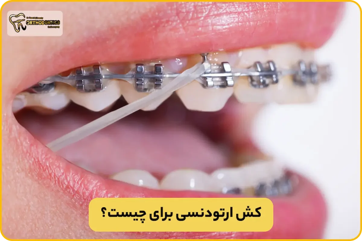 کش ارتودنسی