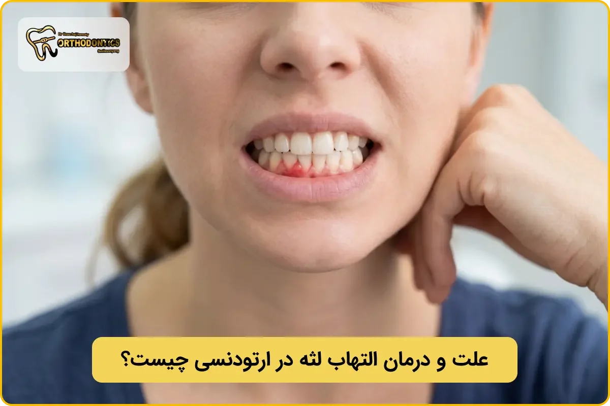 علت التهاب لثه در ارتودنسی