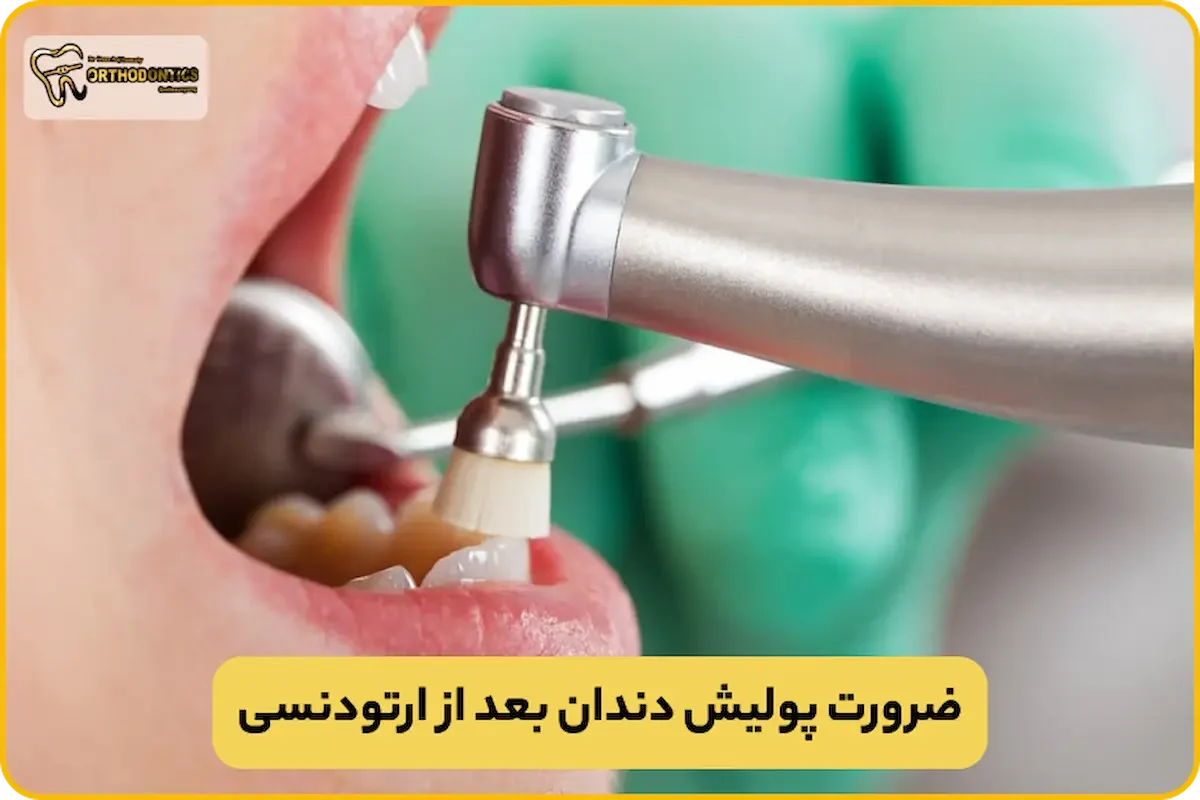 پولیش دندان بعد از ارتودنسی