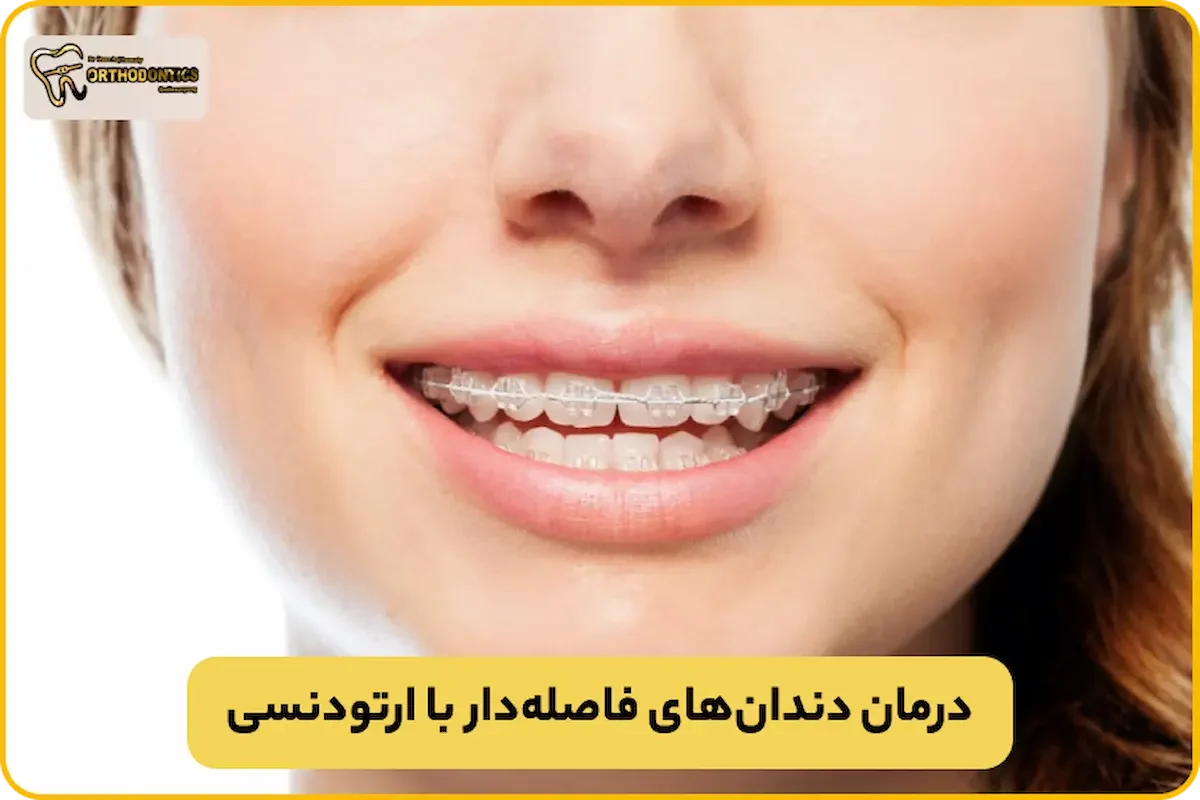ارتودنسی دندان فاصله دار