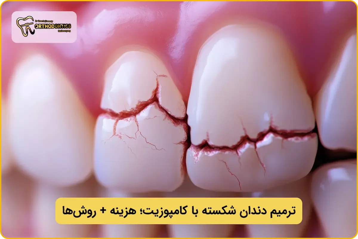 ترمیم دندان با کامپوزیت