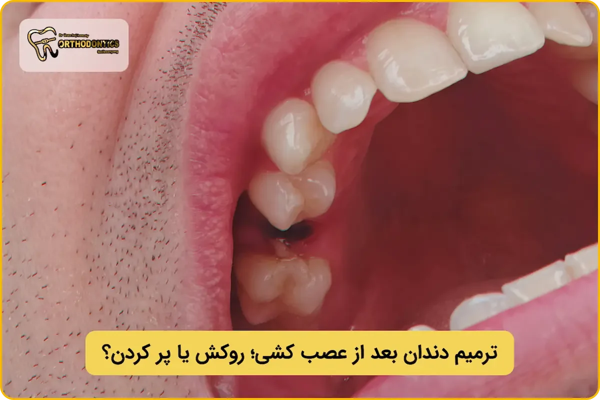 ترمیم دندان عصب کشی شده شکسته