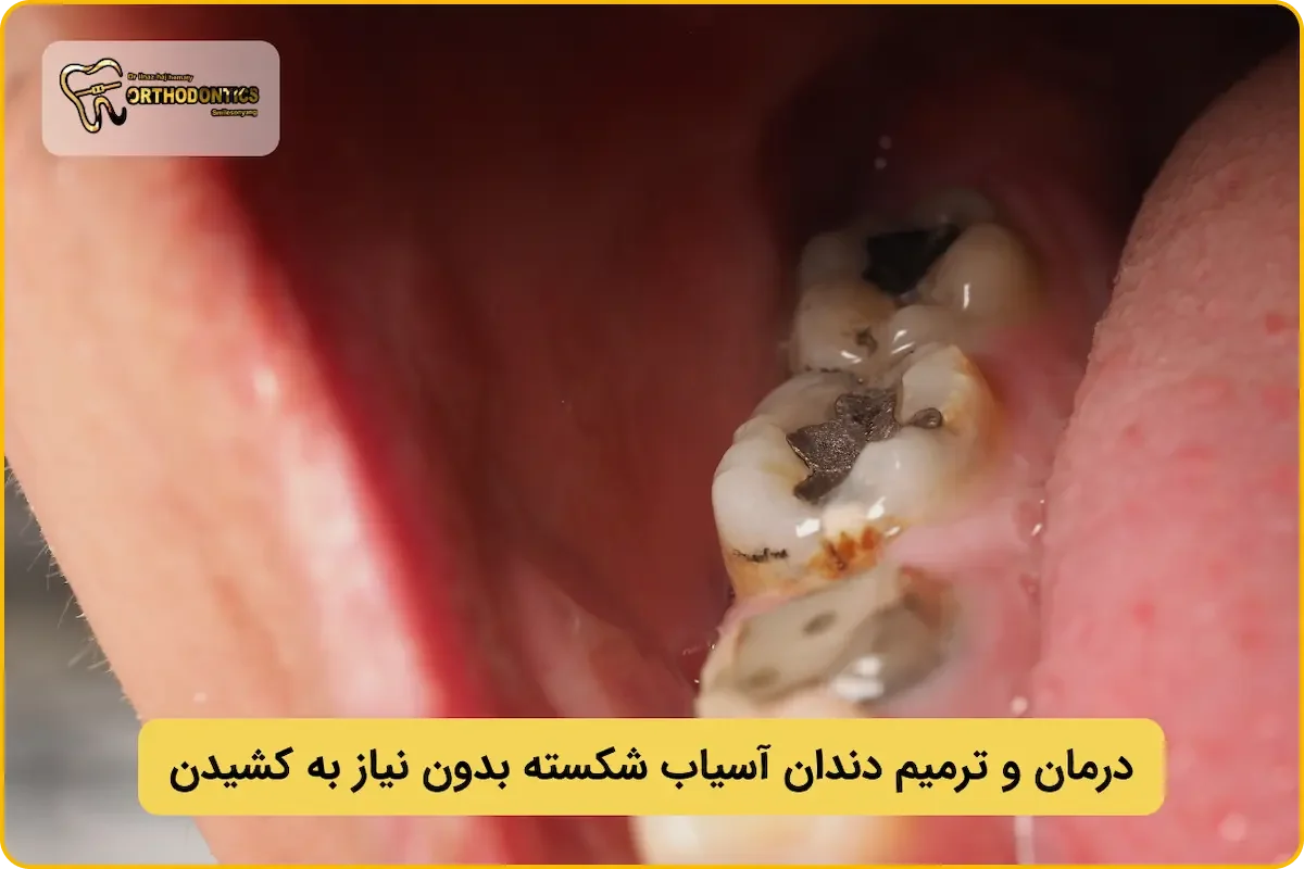 هزینه ترمیم دندان اسیاب شکسته