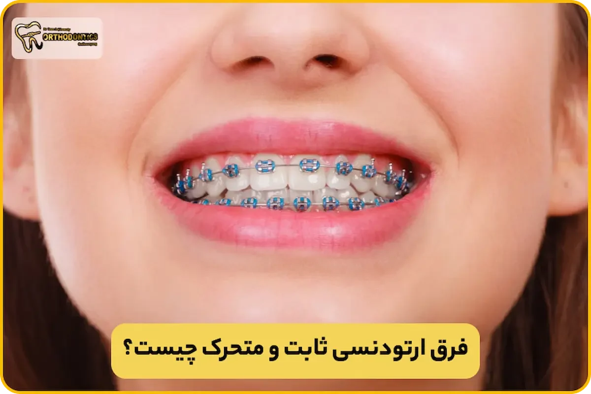 فرق ارتودنسی ثابت و متحرک