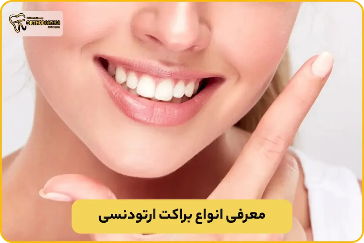 براکت ارتودنسی