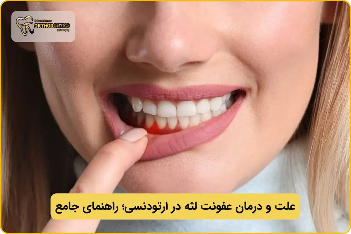 عفونت لثه در ارتودنسی؛ پیشگیری و درمان