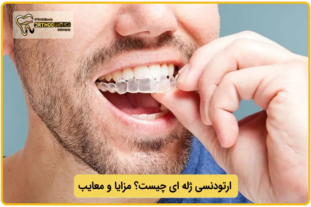 ارتودنسی ژله ای چیست؟
