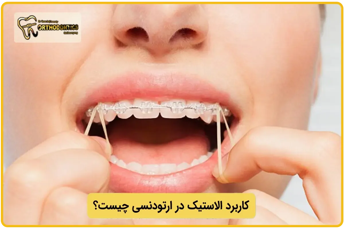 کاربرد الاستیک در ارتودنسی