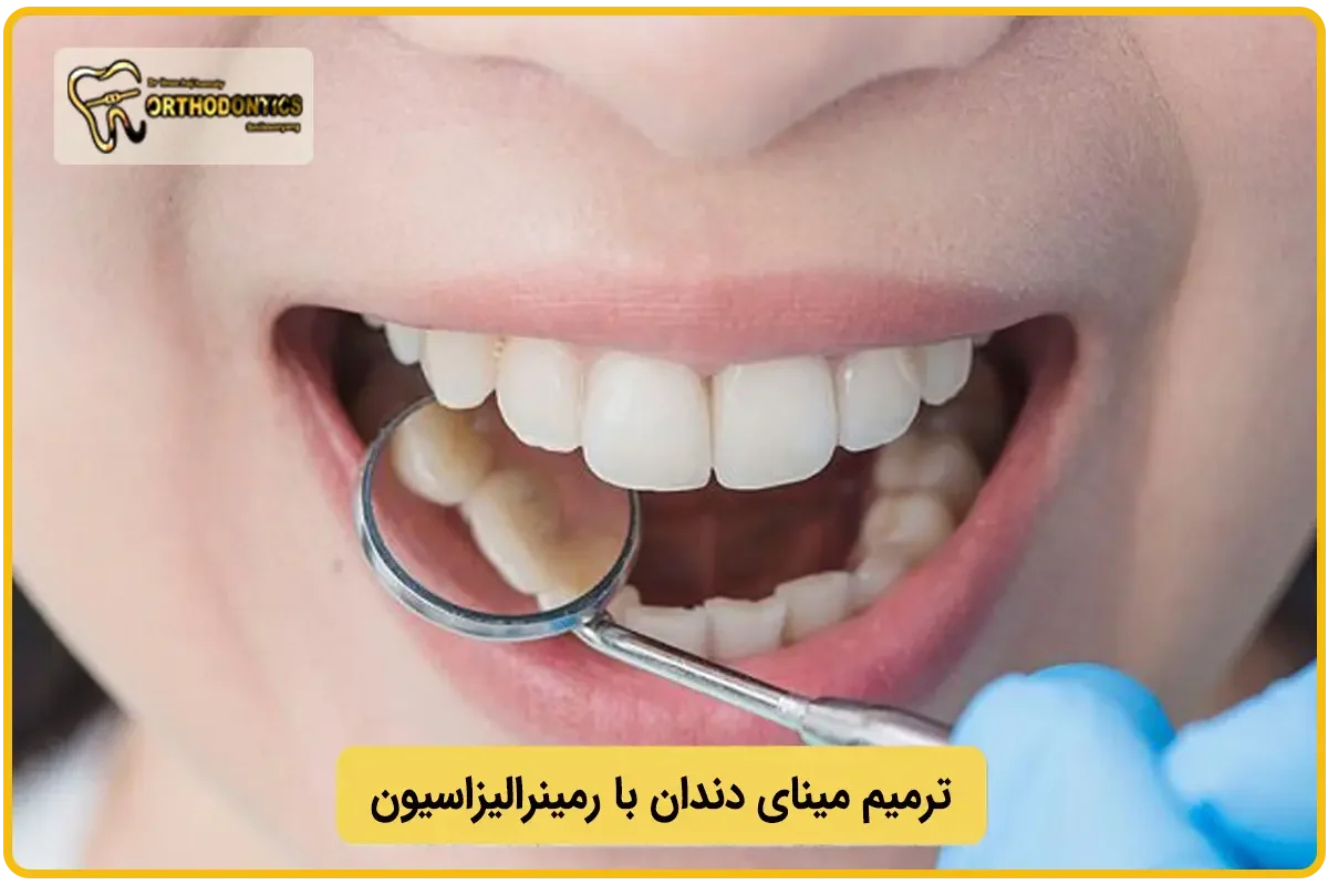 ترمیم مینای دندان با رمینرالیزاسیون